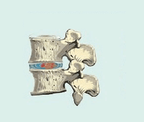 stages of osteochondrosis